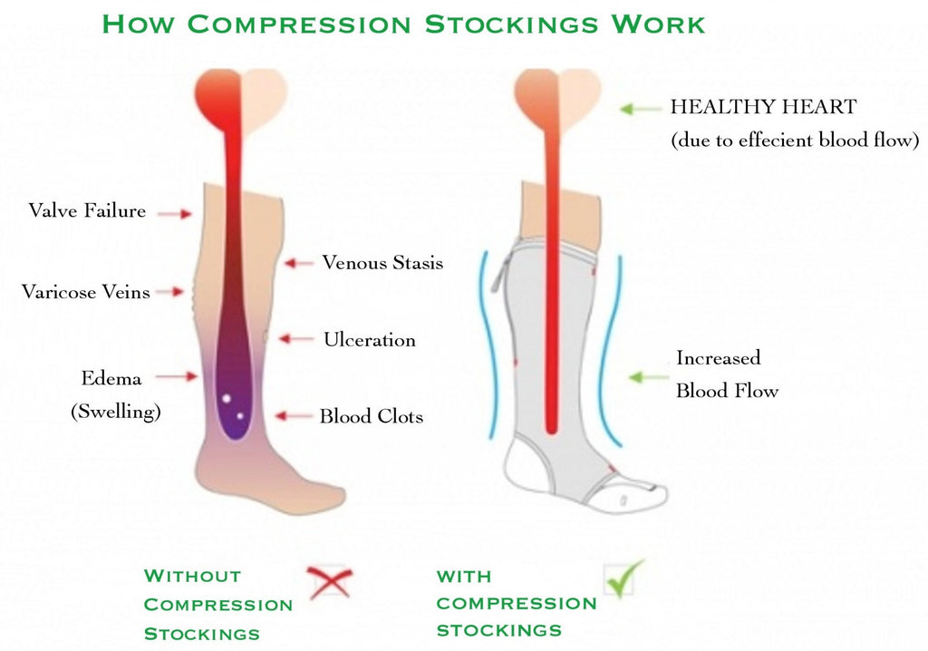 How Compression Socks Work