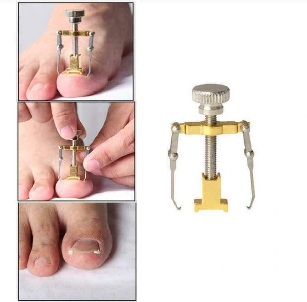 Ingrown Toenail Tool