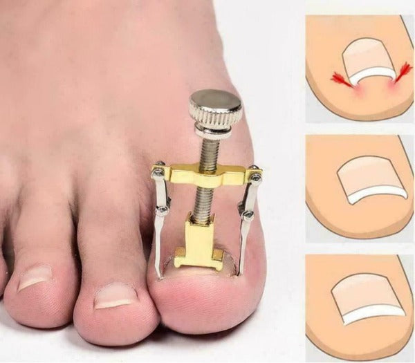 Ingrown Toenail Tool