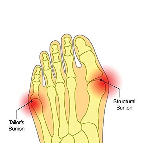 Padded Bunion Protecting Foot Sleeves - Big Toe Corrector Straightner - Pair - Affordable Compression Socks